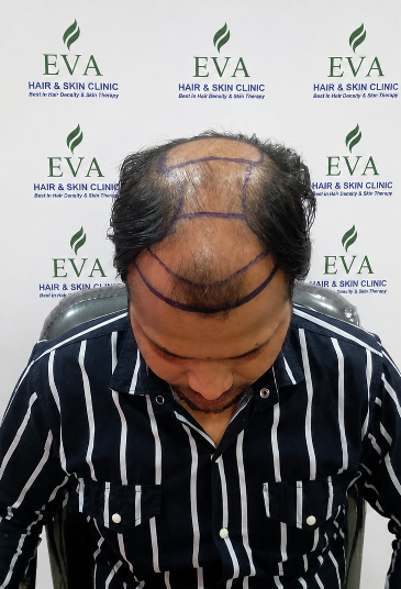 Before hair transplant result 8